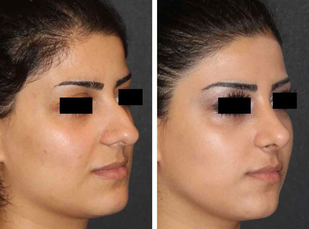 Rhinoplasty Nose Job In Turkey Cost Reviews Before After 2024 